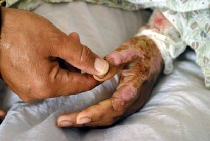 Hands of a woman who has committed self-burning herself in Herat