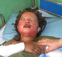 Injured child