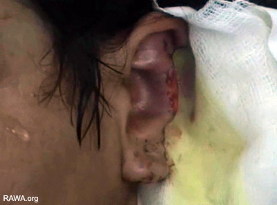 Nafisa's husband cut off her nose and ear