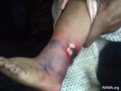 Nafisa's child who was burnt by her husband