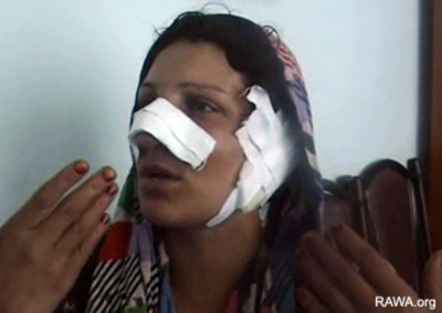 Nafisa's husband cut off her nose and ear